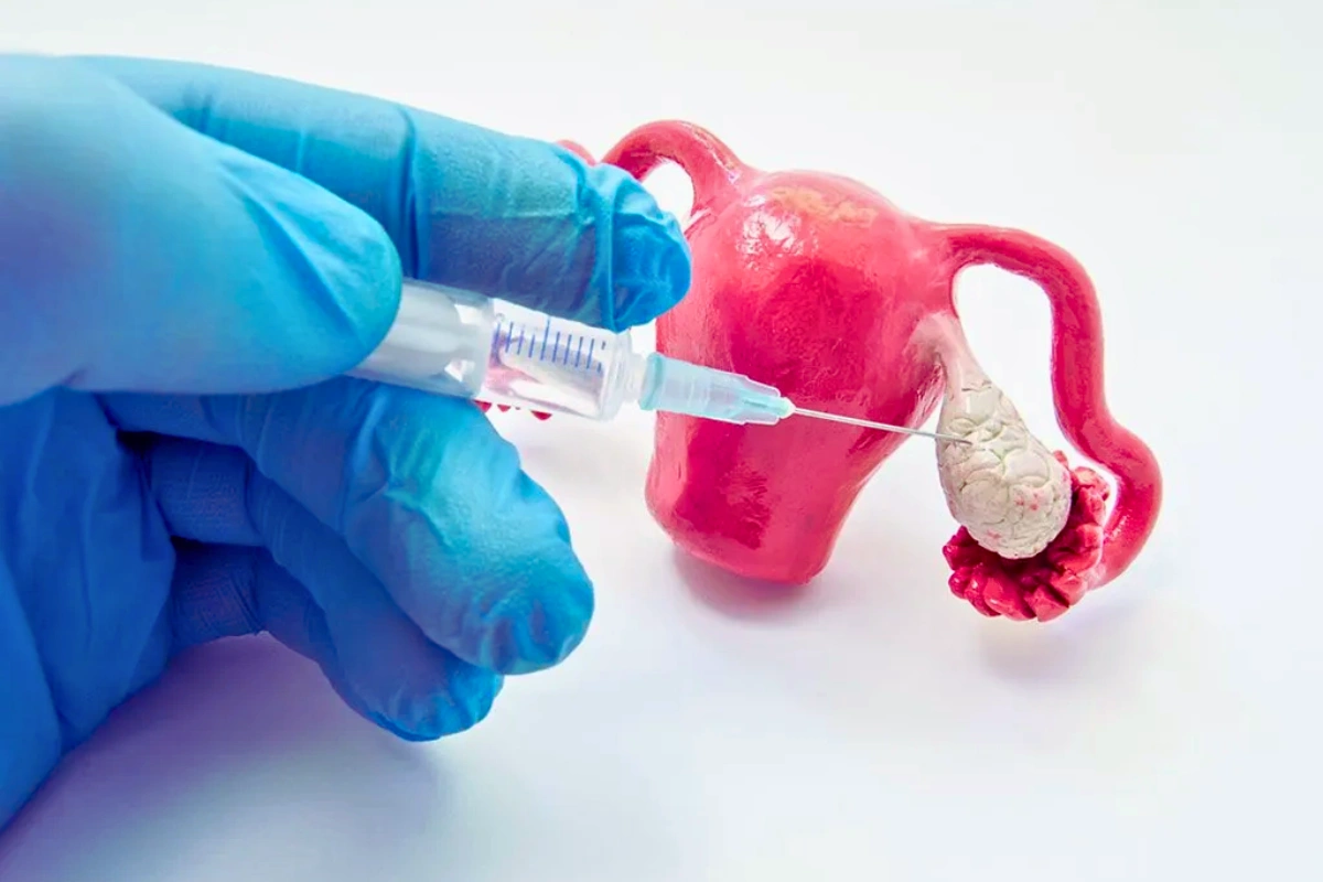 In vitro maturation (IVM )fertility procedure in Goa